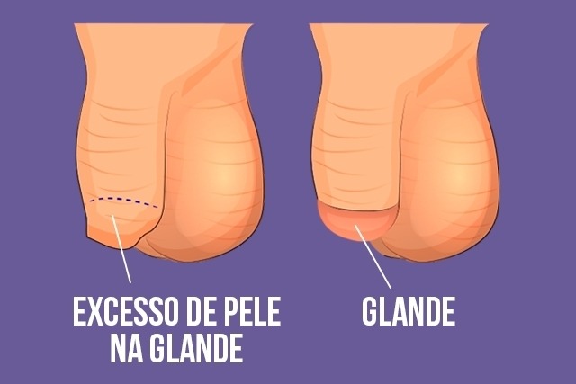 Circuncisão: o que é, para que serve, como é feita e riscos